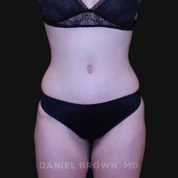 Tummy Tuck Before & After Patient #10929