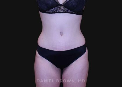Tummy Tuck Before & After Patient #10929