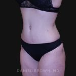 Tummy Tuck Before & After Patient #10929