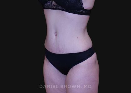 Tummy Tuck Before & After Patient #10929