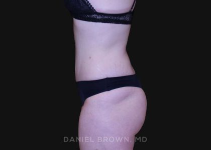 Tummy Tuck Before & After Patient #10929