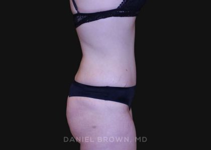 Tummy Tuck Before & After Patient #10929