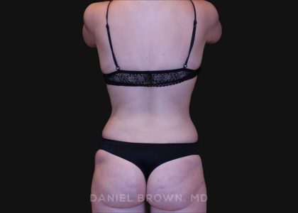 Tummy Tuck Before & After Patient #10929