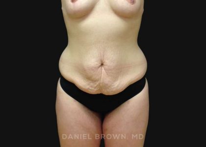 Tummy Tuck Before & After Patient #10929