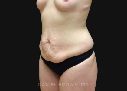 Tummy Tuck Before & After Patient #10929