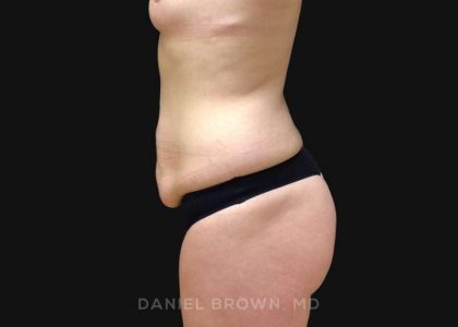 Tummy Tuck Before & After Patient #10929