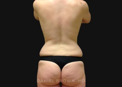 Tummy Tuck Before & After Patient #10929