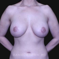 Periareolar Breast Lift Before & After Patient #10643
