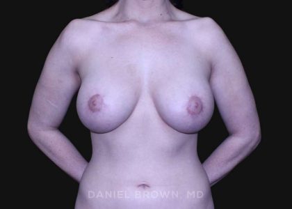 Periareolar Breast Lift Before & After Patient #10643