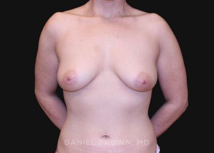 Periareolar Breast Lift Before & After Patient #10643