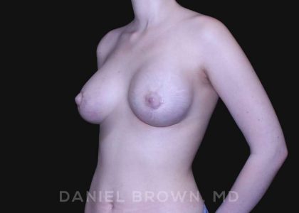Periareolar Breast Lift Before & After Patient #10654