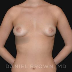 Periareolar Breast Lift Before & After Patient #10654