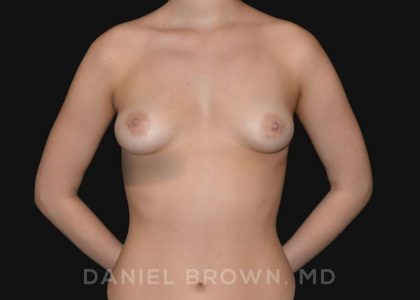Periareolar Breast Lift Before & After Patient #10654