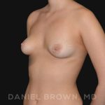 Periareolar Breast Lift Before & After Patient #10654