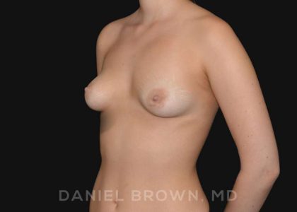 Periareolar Breast Lift Before & After Patient #10654