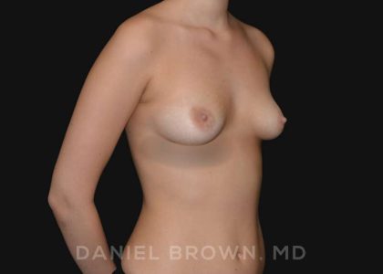 Periareolar Breast Lift Before & After Patient #10654