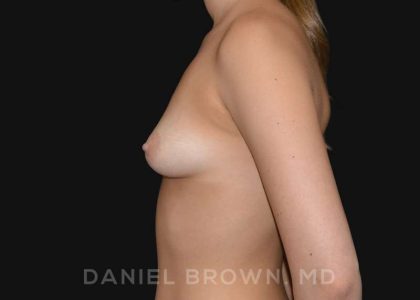 Periareolar Breast Lift Before & After Patient #10654