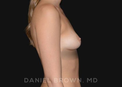 Periareolar Breast Lift Before & After Patient #10654