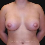Periareolar Breast Lift Before & After Patient #10665