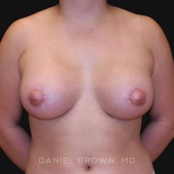 Periareolar Breast Lift Before & After Patient #10665