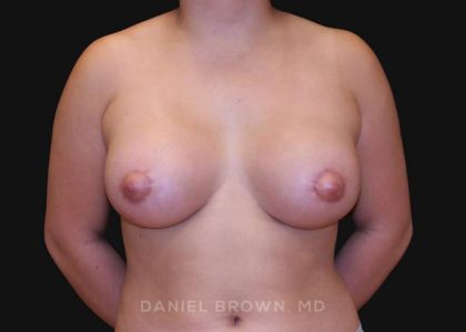 Periareolar Breast Lift Before & After Patient #10665