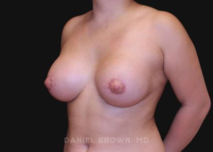 Periareolar Breast Lift Before & After Patient #10665