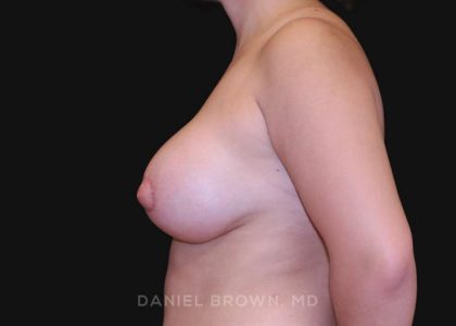 Periareolar Breast Lift Before & After Patient #10665