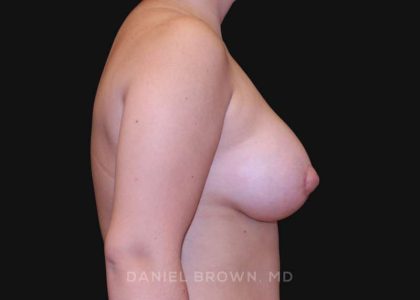 Periareolar Breast Lift Before & After Patient #10665