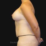 Mommy Makeover Before & After Patient #10367