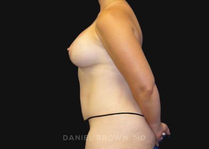 Mommy Makeover Before & After Patient #10367
