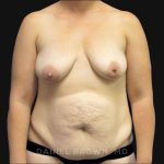 Mommy Makeover Before & After Patient #10367