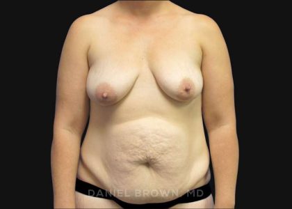Mommy Makeover Before & After Patient #10367
