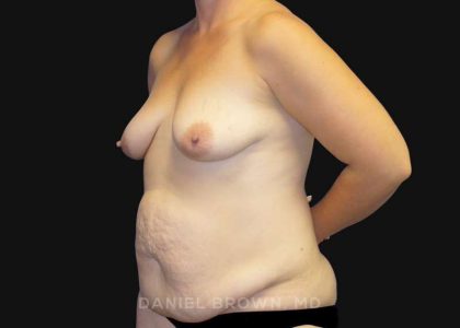 Mommy Makeover Before & After Patient #10367