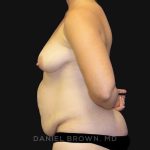 Mommy Makeover Before & After Patient #10367