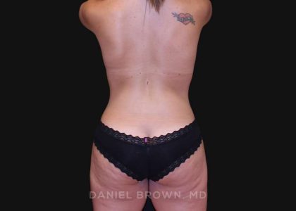 Mommy Makeover Before & After Patient #10380