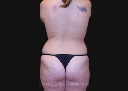 Mommy Makeover Before & After Patient #10380