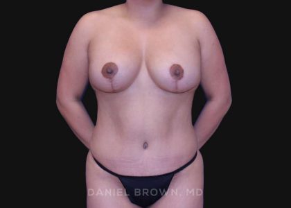 Mommy Makeover Before & After Patient #10393