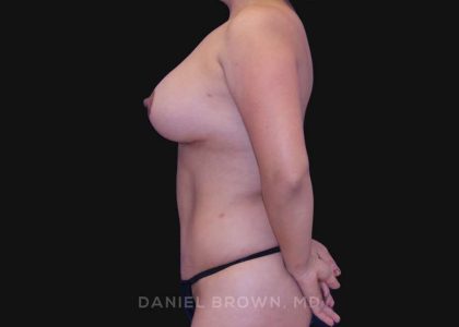 Mommy Makeover Before & After Patient #10393