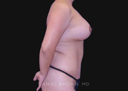 Mommy Makeover Before & After Patient #10393