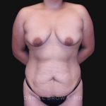 Mommy Makeover Before & After Patient #10393
