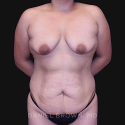 Mommy Makeover Before & After Patient #10393