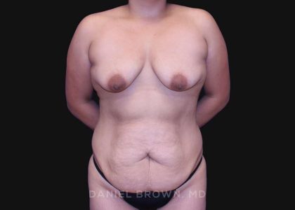 Mommy Makeover Before & After Patient #10393