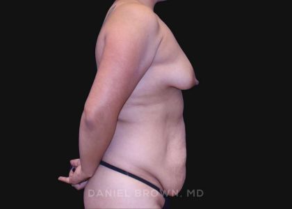 Mommy Makeover Before & After Patient #10393