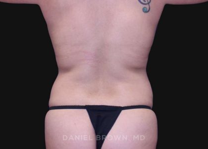 Mommy Makeover Before & After Patient #10393