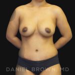 Mommy Makeover Before & After Patient #10404
