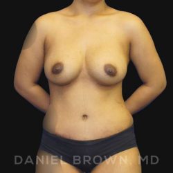 Mommy Makeover Before & After Patient #10404
