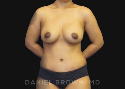 Mommy Makeover Before & After Patient #10404