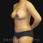Mommy Makeover Before & After Patient #10404