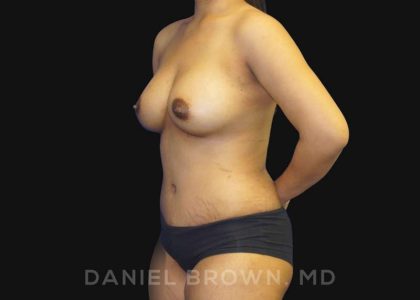 Mommy Makeover Before & After Patient #10404