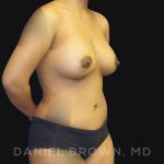 Mommy Makeover Before & After Patient #10404